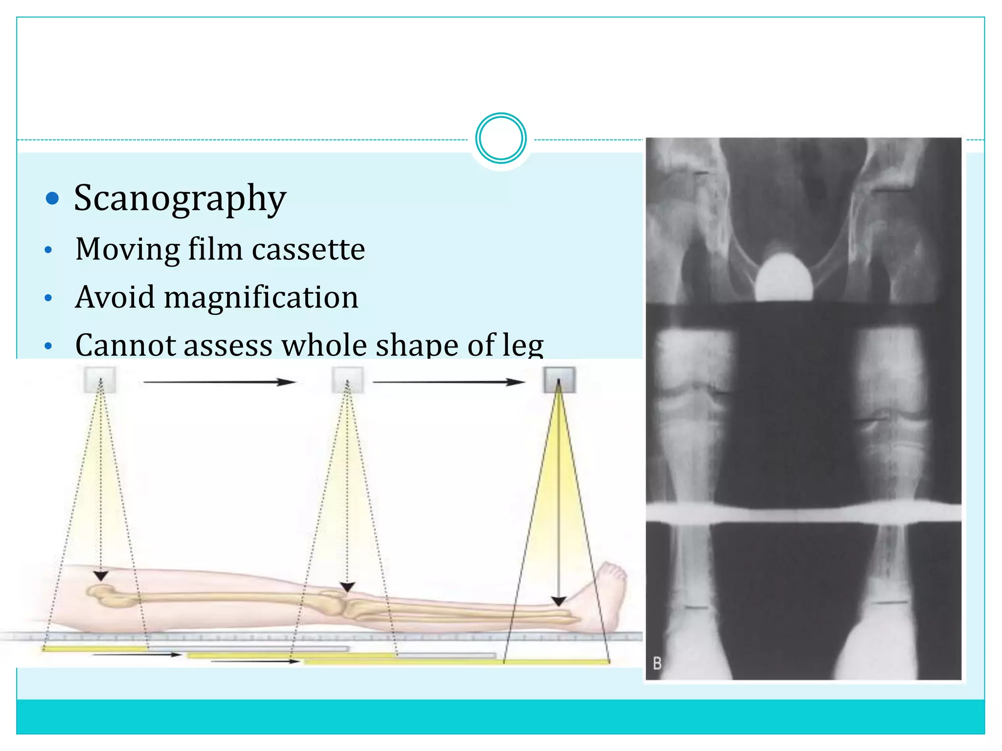  Scanography
• Moving film cassette
• Avoid magnification
• Cannot assess whole shape of leg
 
