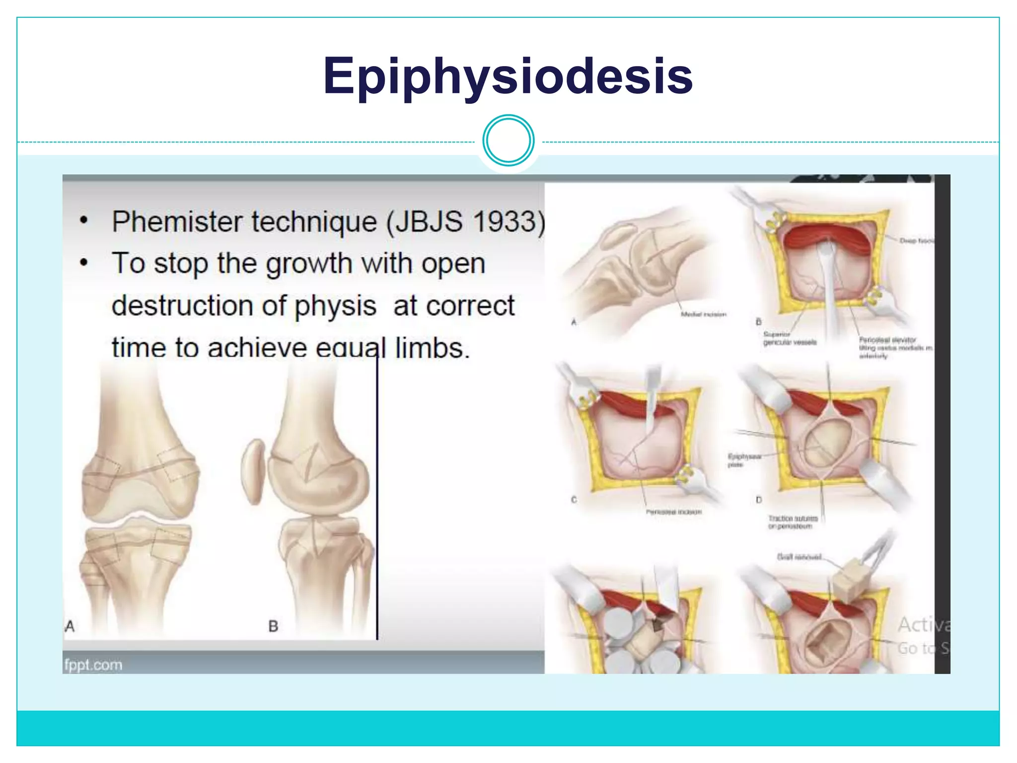 Epiphysiodesis
 