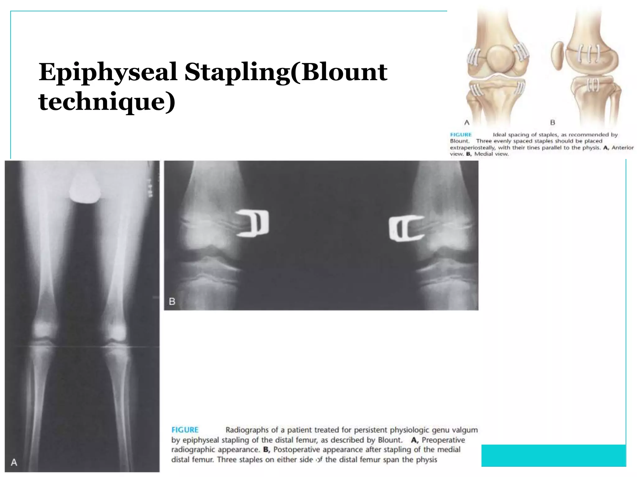 Epiphyseal Stapling(Blount
technique)
37
 
