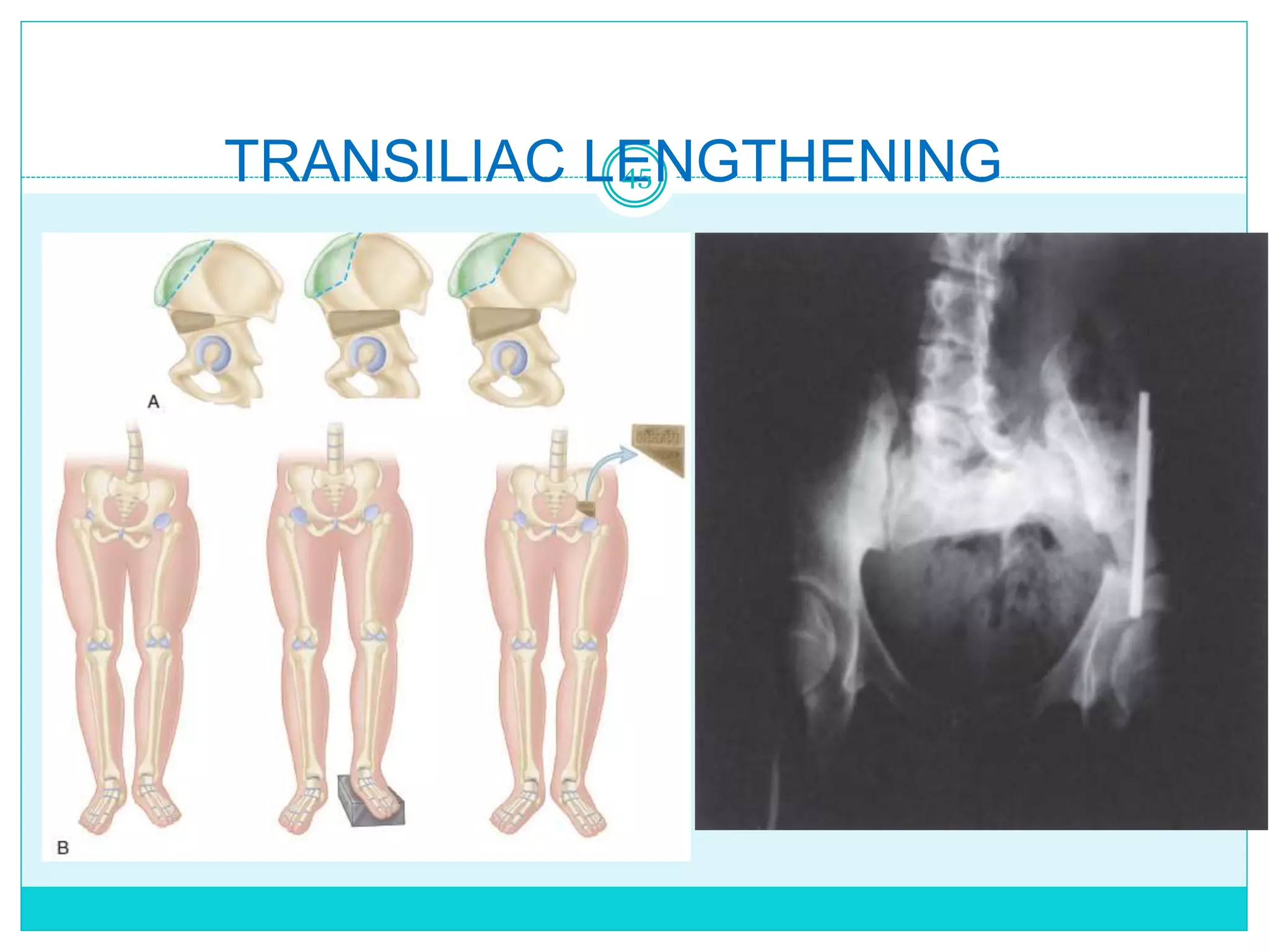 TRANSILIAC LENGTHENING
45
 
