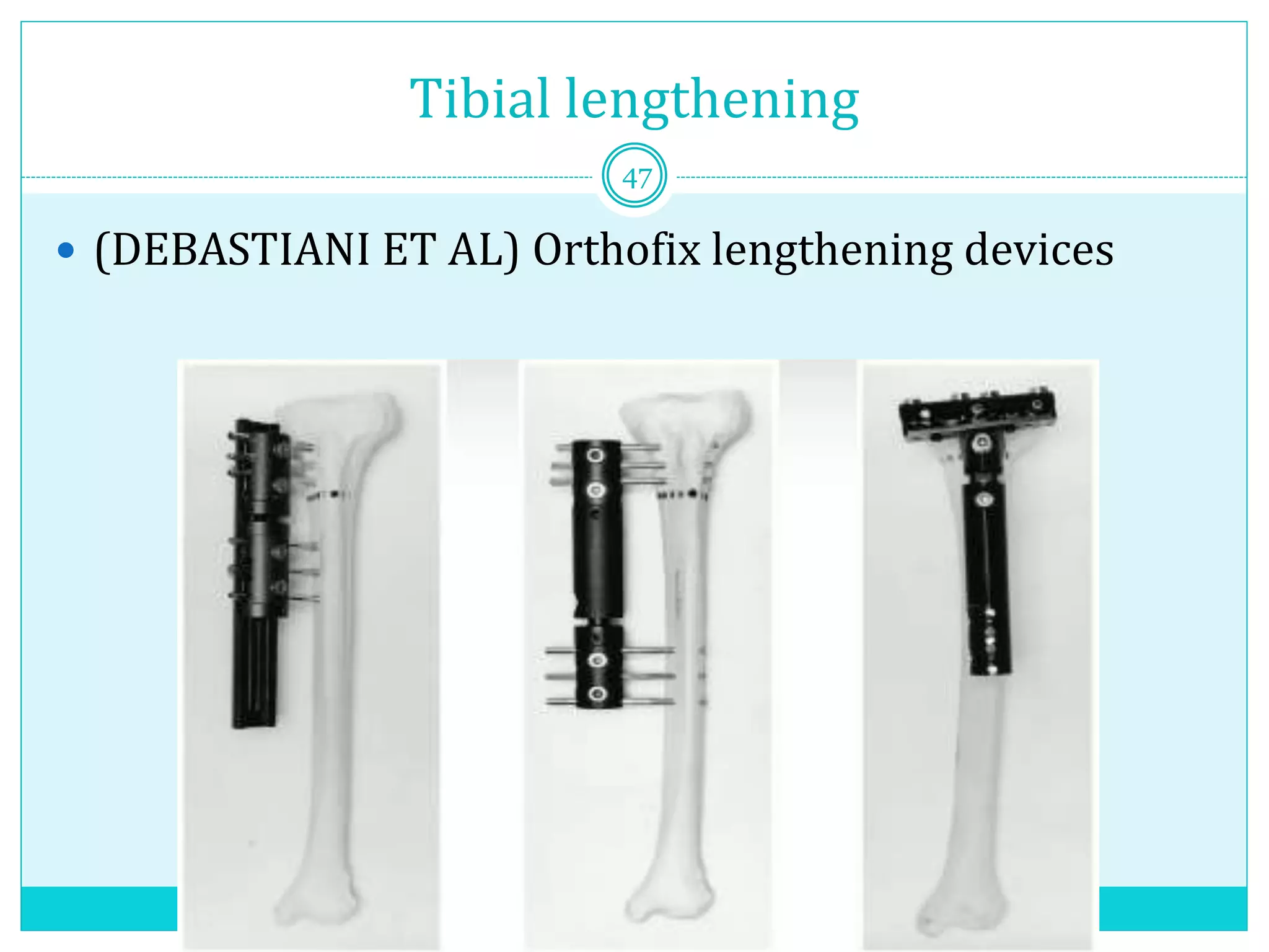 Tibial lengthening
 (DEBASTIANI ET AL) Orthofix lengthening devices
47
 