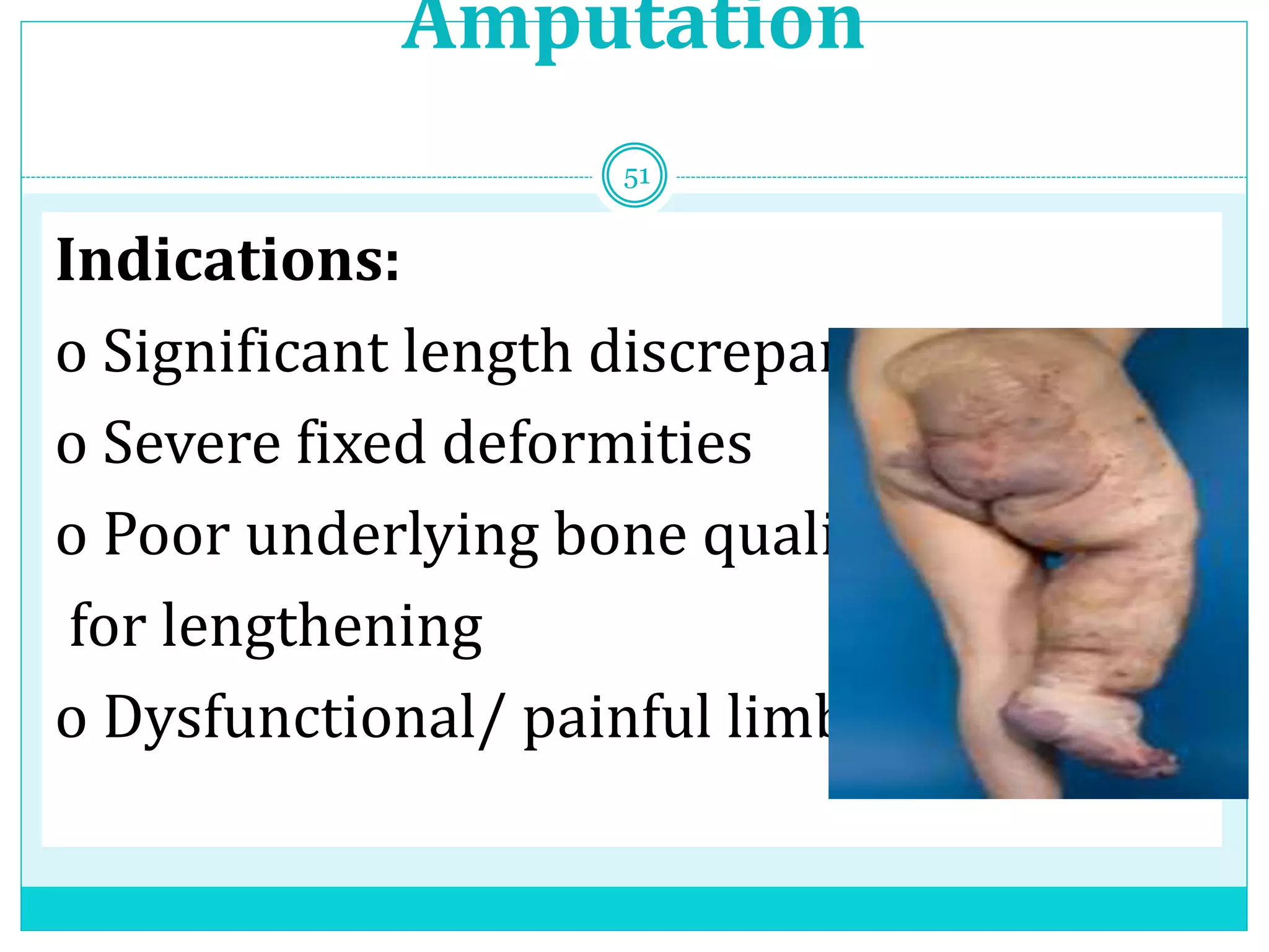 Amputation
Indications:
o Significant length discrepancy
o Severe fixed deformities
o Poor underlying bone quality
for lengthening
o Dysfunctional/ painful limb
51
 