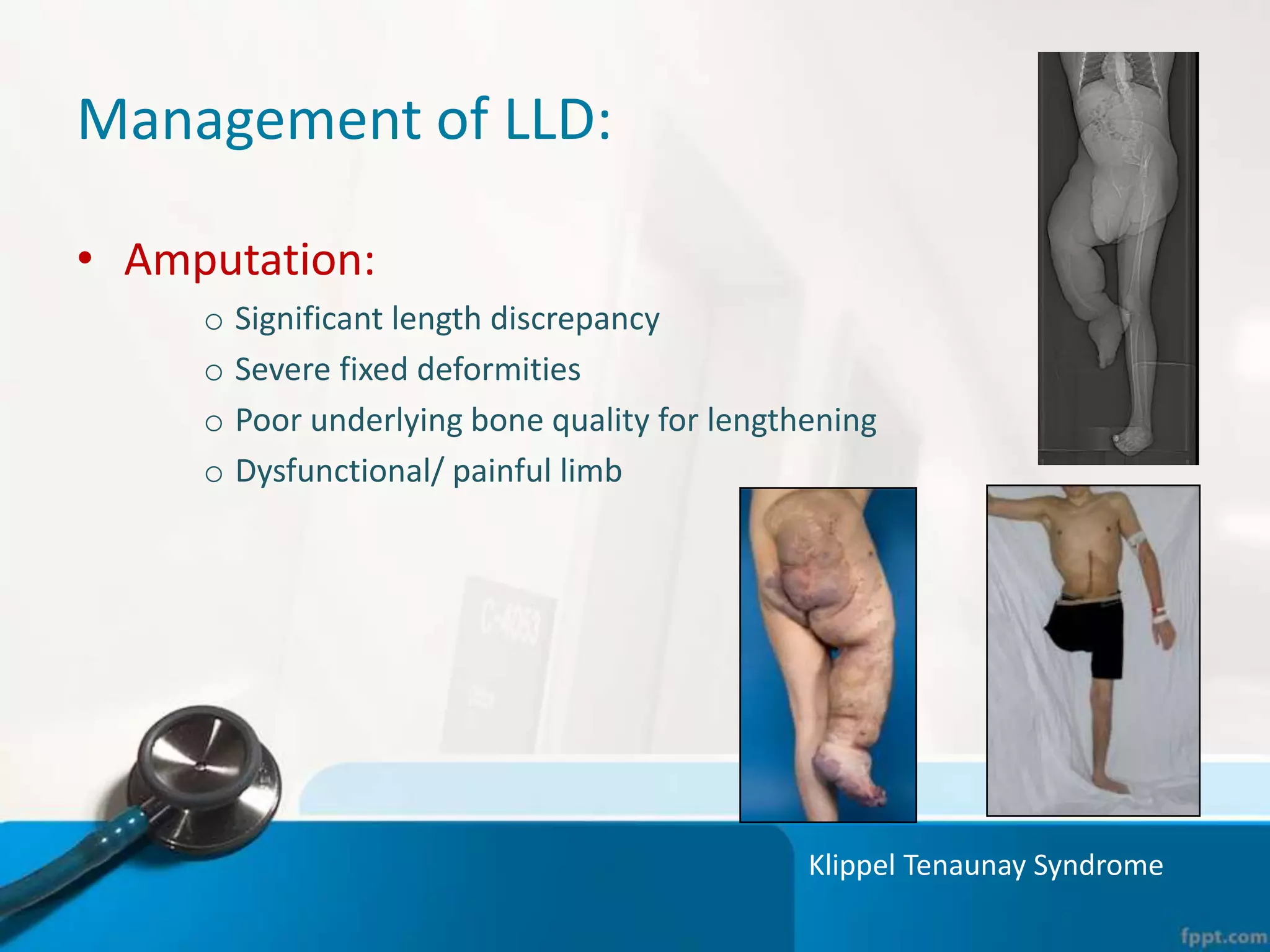 Management of LLD:
• Amputation:
o Significant length discrepancy
o Severe fixed deformities
o Poor underlying bone quality for lengthening
o Dysfunctional/ painful limb
Klippel Tenaunay Syndrome
 