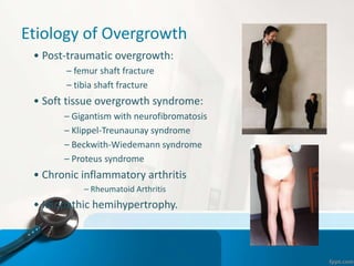 Etiology of Overgrowth
• Post-traumatic overgrowth:
– femur shaft fracture
– tibia shaft fracture
• Soft tissue overgrowth syndrome:
– Gigantism with neurofibromatosis
– Klippel-Treunaunay syndrome
– Beckwith-Wiedemann syndrome
– Proteus syndrome
• Chronic inflammatory arthritis
– Rheumatoid Arthritis
• Idiopathic hemihypertrophy.
 