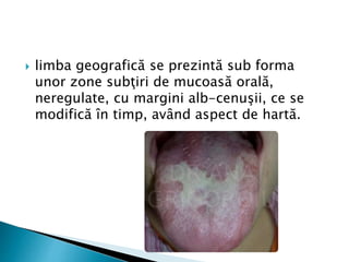  limba geografică se prezintă sub forma
unor zone subţiri de mucoasă orală,
neregulate, cu margini alb-cenuşii, ce se
modifică în timp, având aspect de hartă.
 