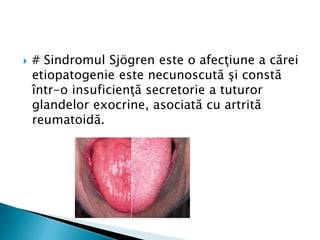  # Sindromul Sjögren este o afecţiune a cărei
etiopatogenie este necunoscută şi constă
într-o insuficienţă secretorie a tuturor
glandelor exocrine, asociată cu artrită
reumatoidă.
 