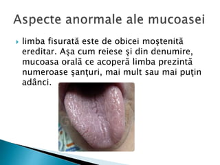  limba fisurată este de obicei moştenită
ereditar. Aşa cum reiese şi din denumire,
mucoasa orală ce acoperă limba prezintă
numeroase şanţuri, mai mult sau mai puţin
adânci.
 