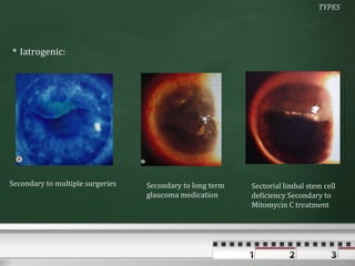 TYPES




 Iatrogenic:




Secondary to multiple surgeries   Secondary to long term   Sectorial limbal stem cell
                                  glaucoma medication      deficiency Secondary to
                                                           Mitomycin C treatment
 