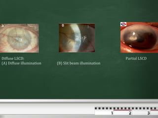 Diffuse LSCD:                                           Partial LSCD
(A) Diffuse illumination   (B) Slit beam illumination
 