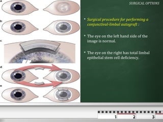 SURGICAL OPTIONS



 Surgical procedure for performing a
  conjunctival-limbal autograft :

 The eye on the left hand side of the
  image is normal.

 The eye on the right has total limbal
  epithelial stem cell deficiency.
 