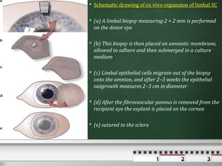  Schematic drawing of ex vivo expansion of limbal SC

 (a) A limbal biopsy measuring 2 × 2 mm is performed
  on the donor eye

 (b) This biopsy is then placed on amniotic membrane,
  allowed to adhere and then submerged in a culture
  medium

 (c) Limbal epithelial cells migrate out of the biopsy
  onto the amnion, and after 2–3 weeks the epithelial
  outgrowth measures 2–3 cm in diameter

 (d) After the fibrovascular pannus is removed from the
  recipient eye the explant is placed on the cornea

 (e) sutured to the sclera
 
