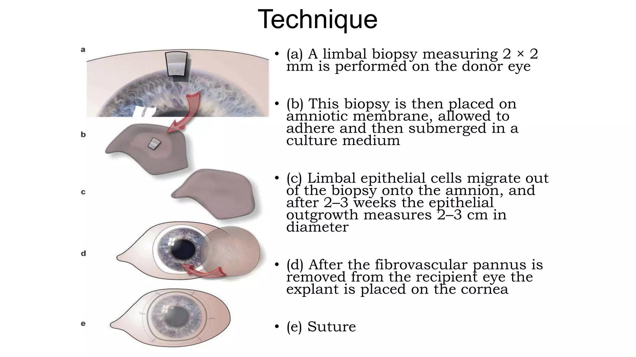 Limbal stem cell deficiency | PPTX