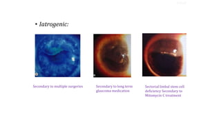 • Iatrogenic:
Secondary to multiple surgeries Secondary to long term
glaucoma medication
Sectorial limbal stem cell
deficiency Secondary to
Mitomycin C treatment
TYPES
 