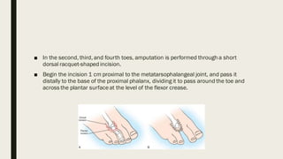 Modified Racquet Incision Foot LIMB AMPUTATION-13453455564565564466.pdf