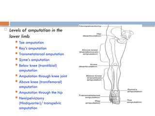  Levels of amputation in the
lower limb
 Toe amputation
 Ray’s amputation
 Transmetatarsal amputation
 Syme’s amputation
 Below knee (transtibial)
amputation
 Amputation through knee joint
 Above knee (transfemoral)
amputation
 Amputation through the hip
 Hemipelvictomy
(Hindquarter)/ transpelvic
amputation
 