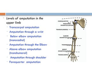 • Levels of amputation in the
upper limb
• Transcarpal amputation
• Amputation through a wrist
• Below elbow amputation
(transradial)
• Amputation through the Elbow
• Above elbow amputation
(transhumeral)
• Amputation through shoulder
• Forequarter amputation
 