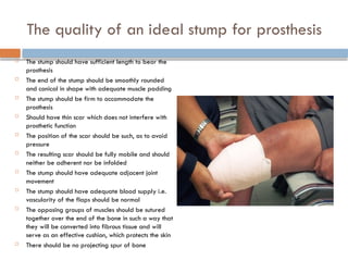 The quality of an ideal stump for prosthesis
 The stump should have sufficient length to bear the
prosthesis
 The end of the stump should be smoothly rounded
and conical in shape with adequate muscle padding
 The stump should be firm to accommodate the
prosthesis
 Should have thin scar which does not interfere with
prosthetic function
 The position of the scar should be such, as to avoid
pressure
 The resulting scar should be fully mobile and should
neither be adherent nor be infolded
 The stump should have adequate adjacent joint
movement
 The stump should have adequate blood supply i.e.
vascularity of the flaps should be normal
 The opposing groups of muscles should be sutured
together over the end of the bone in such a way that
they will be converted into fibrous tissue and will
serve as an effective cushion, which protects the skin
 There should be no projecting spur of bone
 