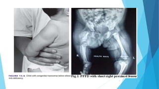 Limb deficiencies and amputations | PPTX