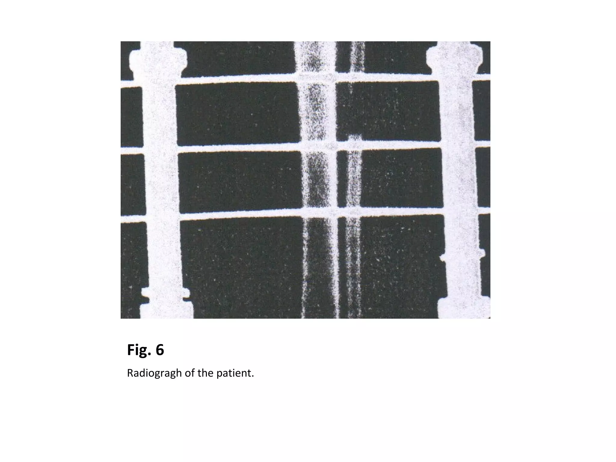 Fig. 6
Radiogragh of the patient.
 
