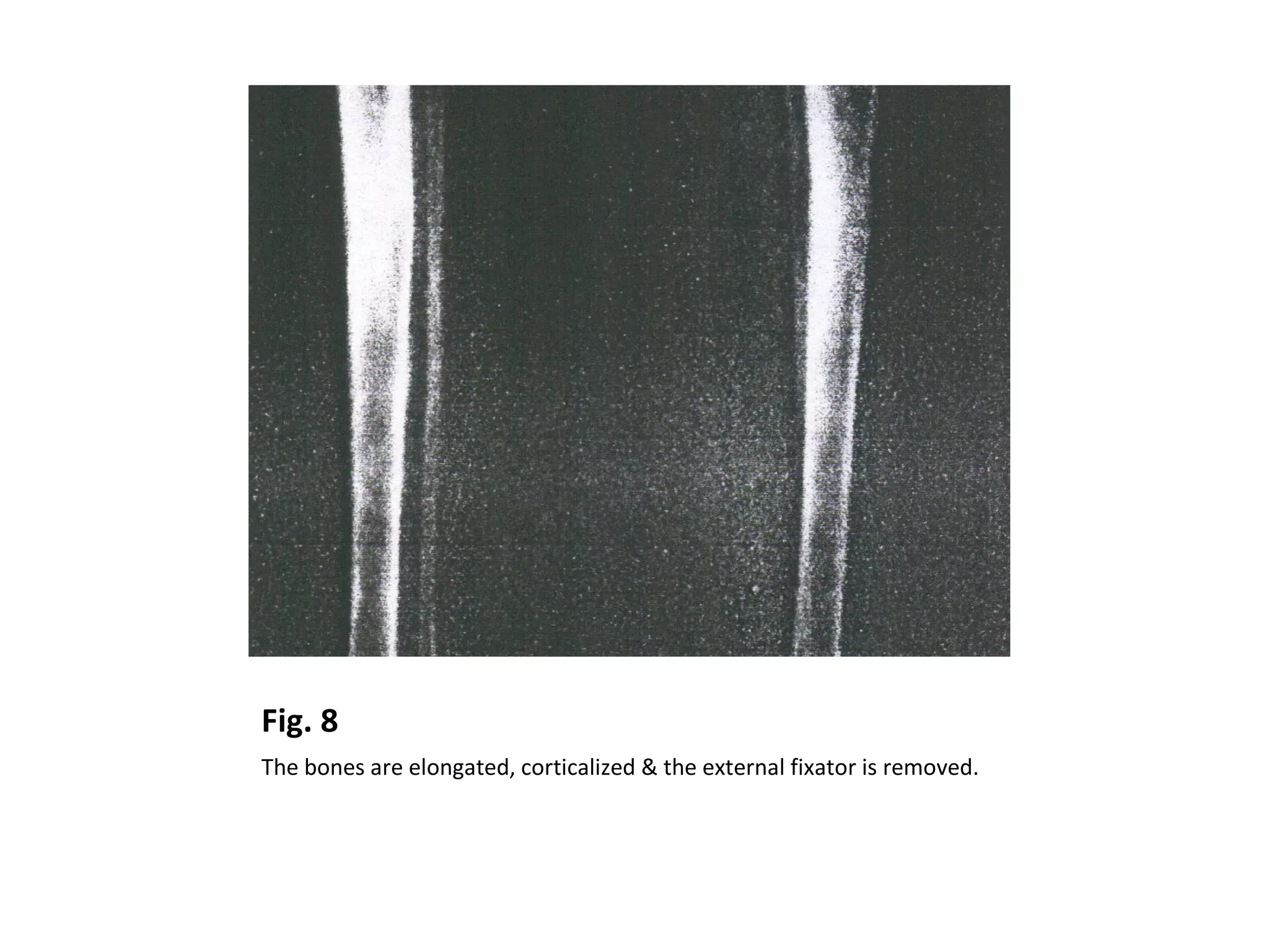 Fig. 8
The bones are elongated, corticalized & the external fixator is removed.
 
