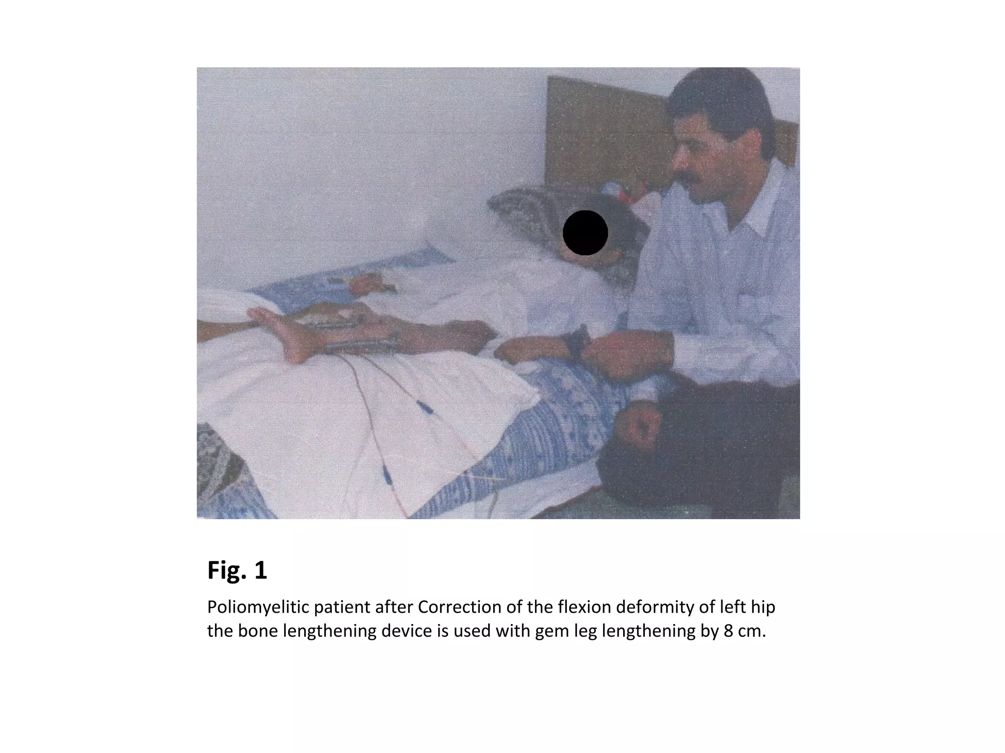 Fig. 1
Poliomyelitic patient after Correction of the flexion deformity of left hip
the bone lengthening device is used with gem leg lengthening by 8 cm.
 