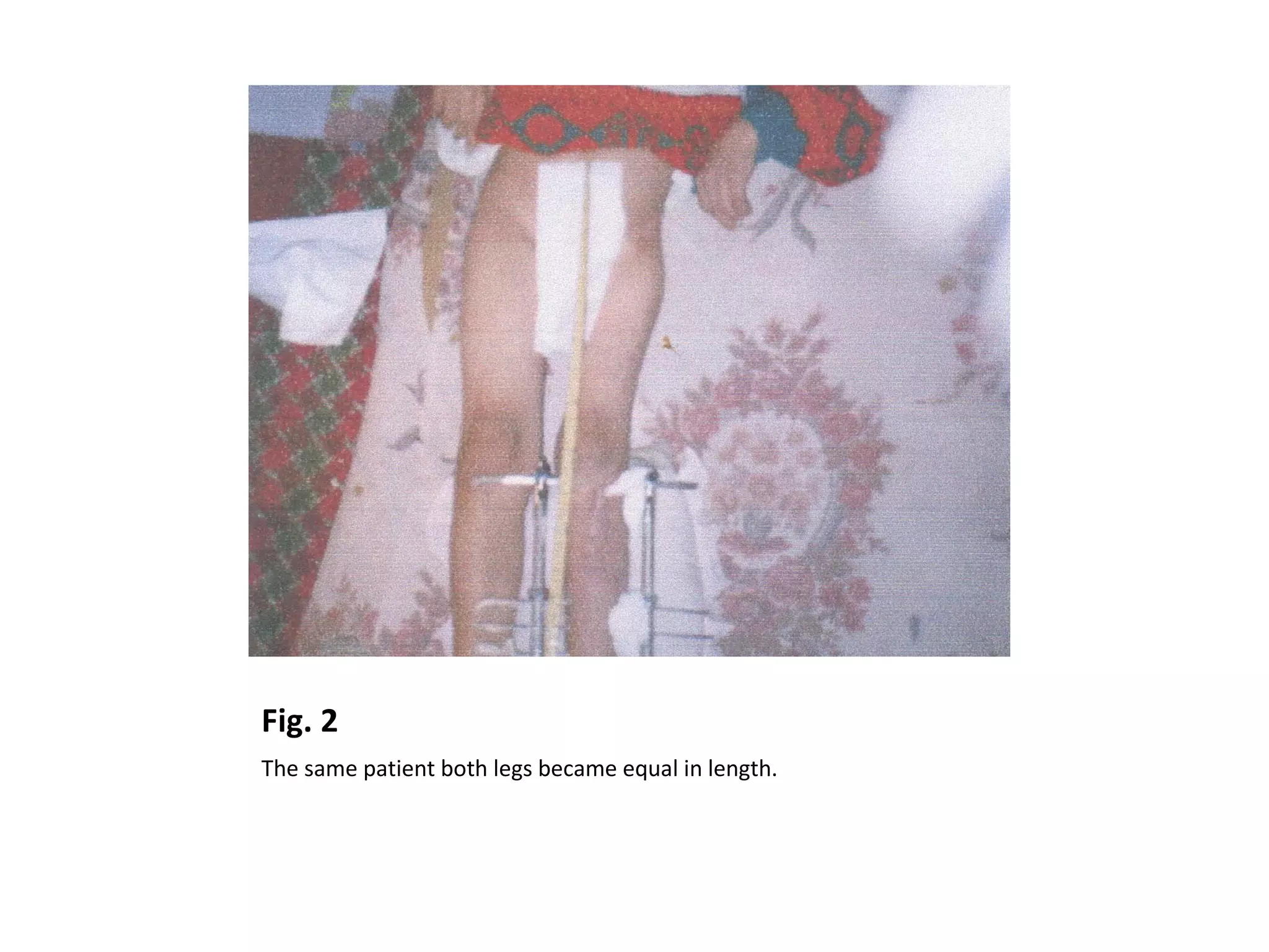 Fig. 2
The same patient both legs became equal in length.
 
