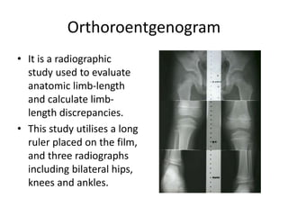 Bone Length Radiograph With Ruler Limb length discrepancy | PPTX