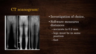 CT scanogram:
• Investigation of choice,
• Software measures
distances
–accurate to 0.2 mm
–legs must be in same
position
–fast
 