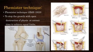 Phemister technique:
• Phemister technique (JBJS 1933):
• To stop the growth with open
destruction of physis at correct
time to achieve equal limbs.
 