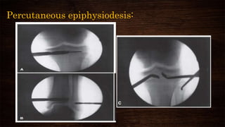 Percutaneous epiphysiodesis:
 