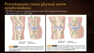 Percutaneous trans physeal screw
epiphysiodesis:
PETS(Percutaneous Epiphysiodesis using Trans epiphyseal Screws )
(Metaizeau JP, et al, JPO,1998)
 