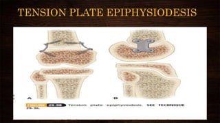 TENSION PLATE EPIPHYSIODESIS
 