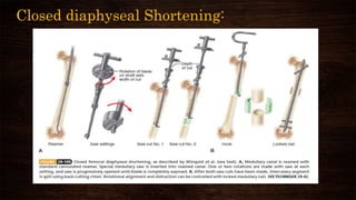 Closed diaphyseal Shortening:
 