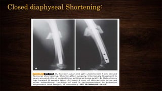 Closed diaphyseal Shortening:
 