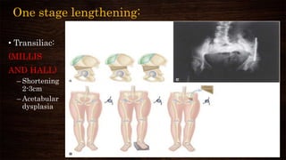 One stage lengthening:
• Transiliac:
(MILLIS
AND HALL)
– Shortening
2-3cm
– Acetabular
dysplasia
 