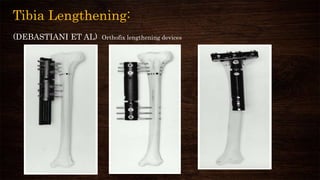 Tibia Lengthening:
(DEBASTIANI ET AL) Orthofix lengthening devices
 