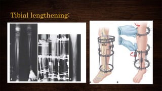 Tibial lengthening:
 