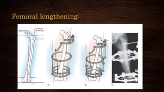 Femoral lengthening:
 