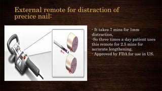 External remote for distraction of
precice nail:
- It takes 7 mins for 1mm
distraction,
-So three times a day patient uses
this remote for 2.5 mins for
accurate lengthening,
- Approved by FDA for use in US.
 