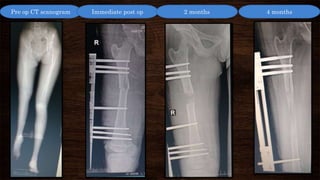 Pre op CT scanogram Immediate post op 2 months 4 months
 