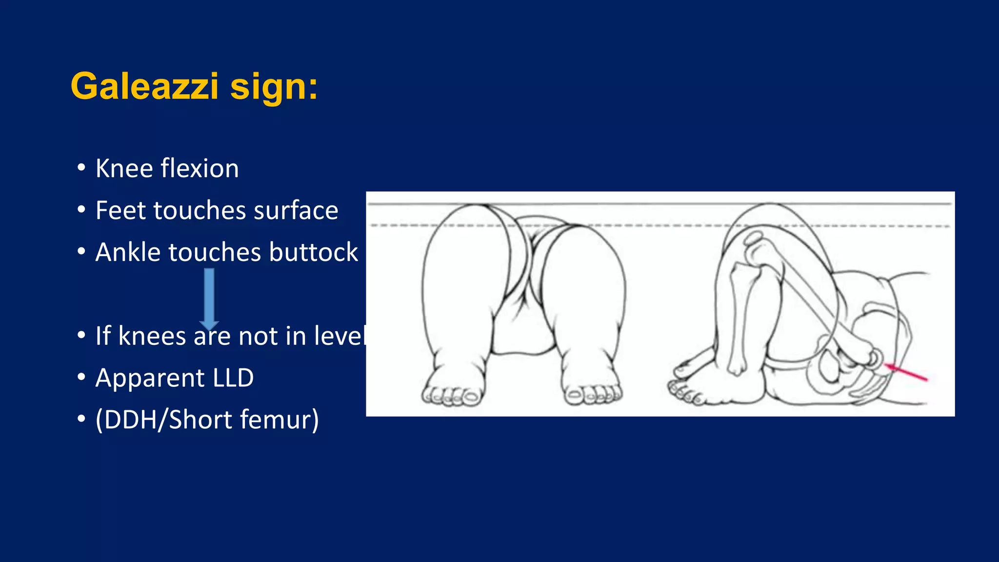 Galeazzi sign:
• Knee flexion
• Feet touches surface
• Ankle touches buttock
• If knees are not in level
• Apparent LLD
• (DDH/Short femur)
 