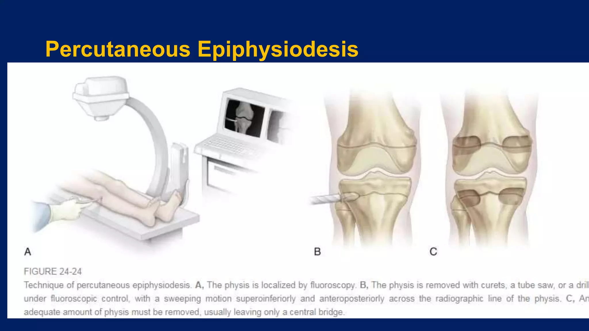Percutaneous Epiphysiodesis
 