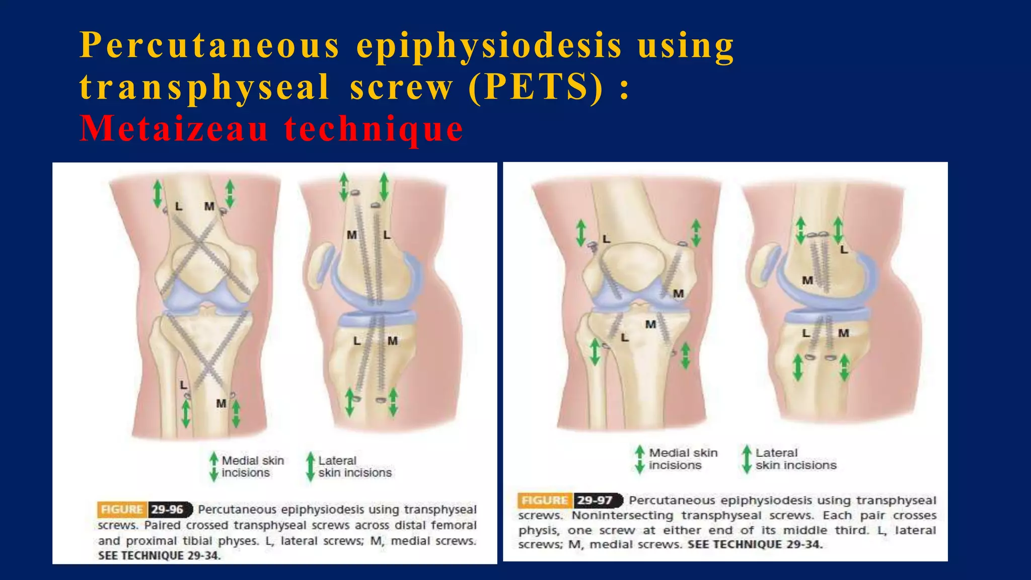 Percutaneous epiphysiodesis using
transphyseal screw (PETS) :
Metaizeau technique
 