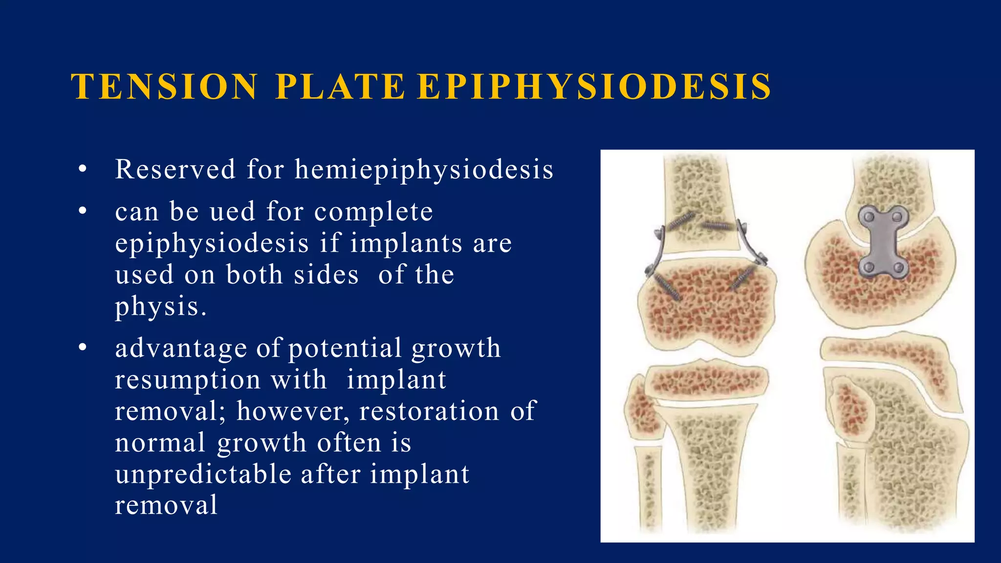 TENSION PLATE EPIPHYSIODESIS
• Reserved for hemiepiphysiodesis
• can be ued for complete
epiphysiodesis if implants are
used on both sides of the
physis.
• advantage of potential growth
resumption with implant
removal; however, restoration of
normal growth often is
unpredictable after implant
removal
 