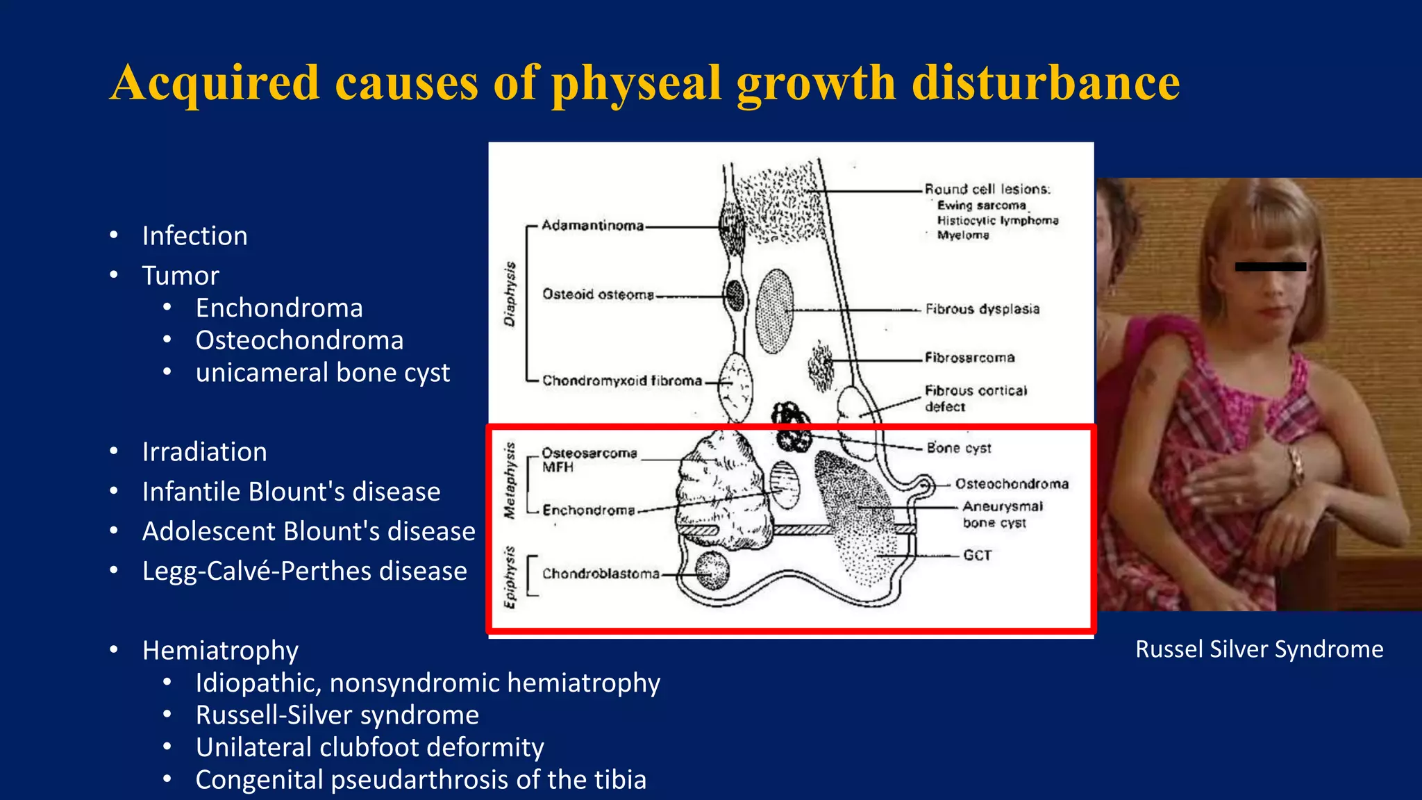 Acquired causes of physeal growth disturbance
• Infection
• Tumor
• Enchondroma
• Osteochondroma
• unicameral bone cyst
• Irradiation
• Infantile Blount's disease
• Adolescent Blount's disease
• Legg-Calvé-Perthes disease
• Hemiatrophy
• Idiopathic, nonsyndromic hemiatrophy
• Russell-Silver syndrome
• Unilateral clubfoot deformity
• Congenital pseudarthrosis of the tibia
Russel Silver Syndrome
 