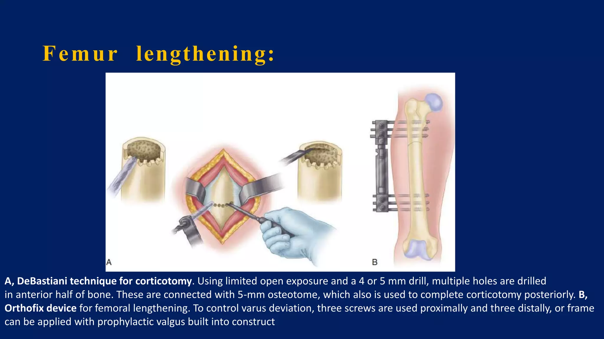 Femur lengthening:
A, DeBastiani technique for corticotomy. Using limited open exposure and a 4 or 5 mm drill, multiple holes are drilled
in anterior half of bone. These are connected with 5-mm osteotome, which also is used to complete corticotomy posteriorly. B,
Orthofix device for femoral lengthening. To control varus deviation, three screws are used proximally and three distally, or frame
can be applied with prophylactic valgus built into construct
 