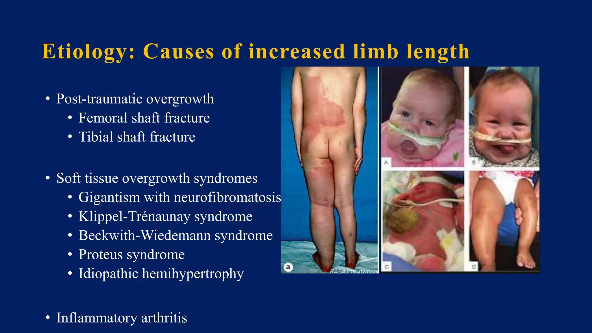 Etiology: Causes of increased limb length
• Post-traumatic overgrowth
• Femoral shaft fracture
• Tibial shaft fracture
• Soft tissue overgrowth syndromes
• Gigantism with neurofibromatosis
• Klippel-Trénaunay syndrome
• Beckwith-Wiedemann syndrome
• Proteus syndrome
• Idiopathic hemihypertrophy
• Inflammatory arthritis
 