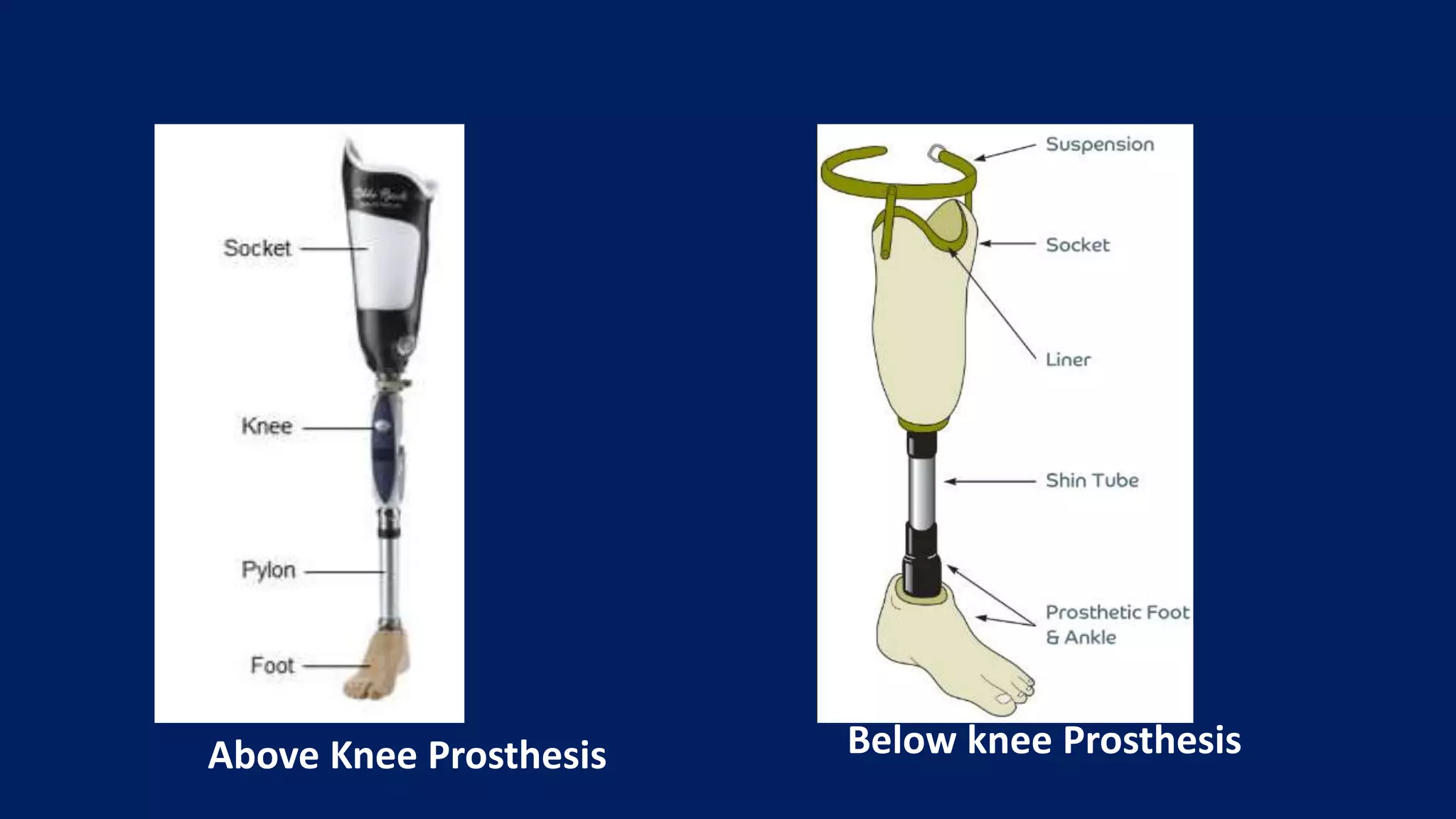 Above Knee Prosthesis Below knee Prosthesis
 