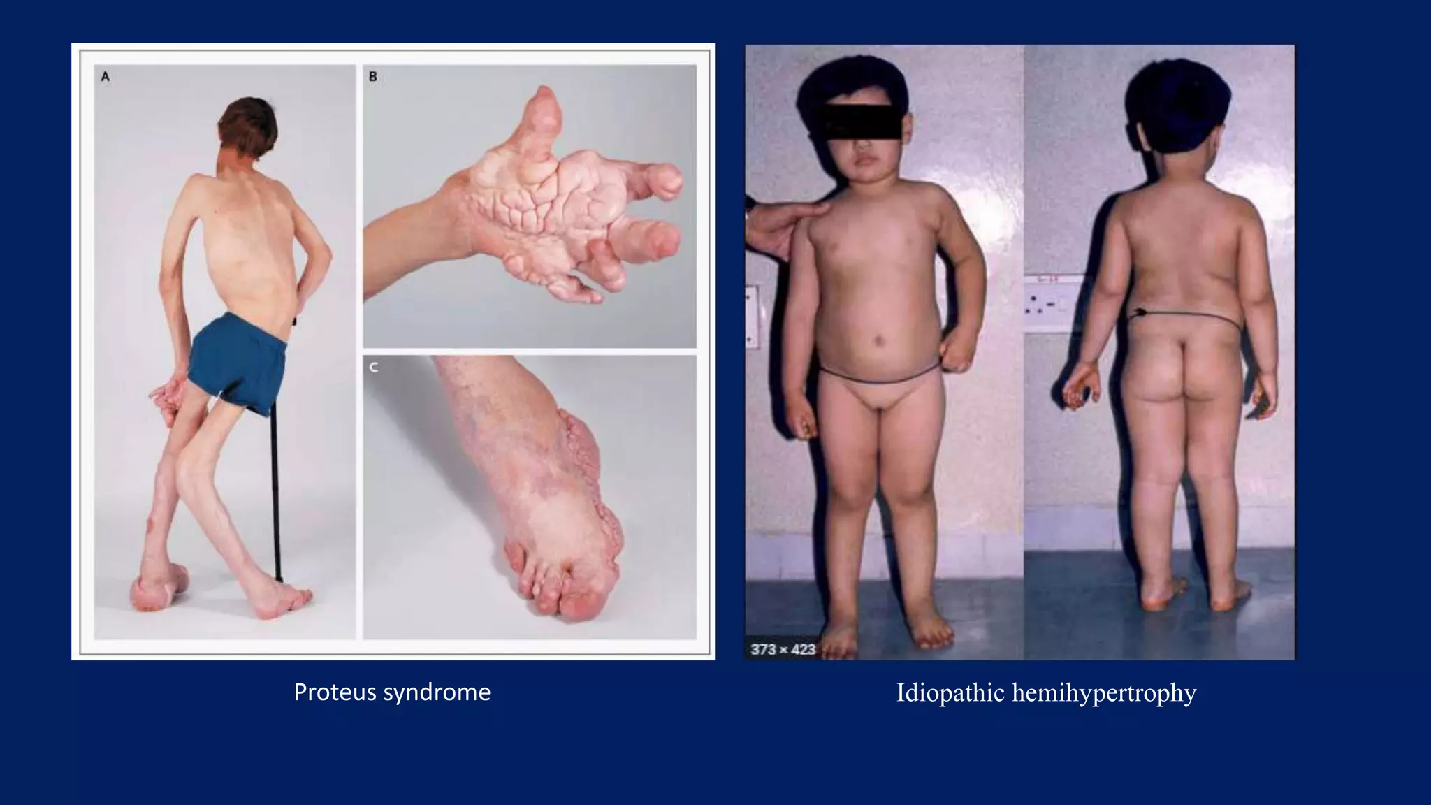 Proteus syndrome Idiopathic hemihypertrophy
 