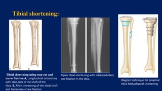 Limb length discrepancy | PPTX